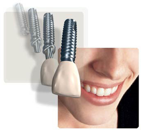 ایمپلنت فوری دندان بدون درد در یک جلسه، برای بازسازی ریشه و تاج دندان