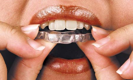 درمان دندان قروچه (براکسیسم) و ساییدن دندان با کاهش استرس و گارد