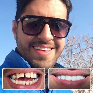 بستن فاصله بین دندان‌ (دیاستم) و جفت شدن دندان های فاصله دار با 6 روش