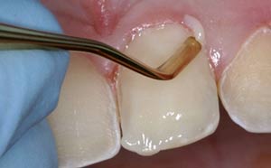 باندینگ دندان: ترمیم و زیبایی دندان با کامپوزیت رزین همرنگ دندان