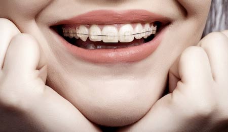 درمان ارتودنسی برای بستن فاصله بین دندان‌