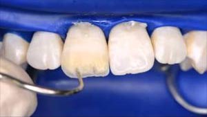 بستن فاصله بین دندان‌ با استفاده از کامپوزیت باندینگ