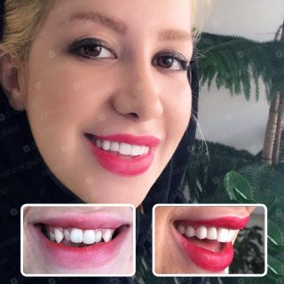اصلاح نامرتبی دندان ها