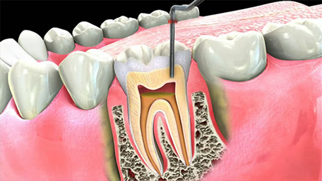 عصب کشی (روت کانال تراپی): درمان عفونت پالپ و ریشه دندان