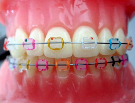 از ارتودنسی با براکت سرامیکی (شفاف و همرنگ دندان) چه می دانید؟
