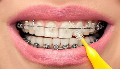 از ارتودنسی با براکت سرامیکی (شفاف و همرنگ دندان) چه می دانید؟