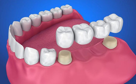 تقویت و ترمیم مینای دندان با تغذیه و درمان های دندان پزشکی