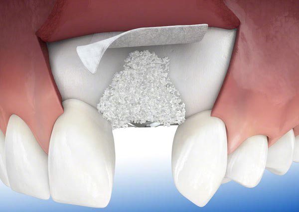 پیوند استخوان فک قبل ایمپلنت:افزایش تراکم استخوان برای کاشت دندان