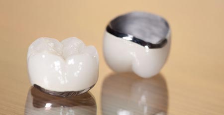 بریج دندان:پر کردن فضای خالی بین دو یا چند دندان با پل دندانی
