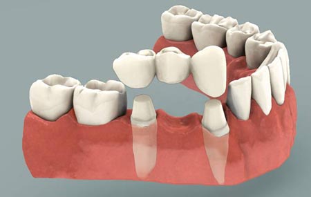 بریج دندان:پر کردن فضای خالی بین دو یا چند دندان با پل دندانی