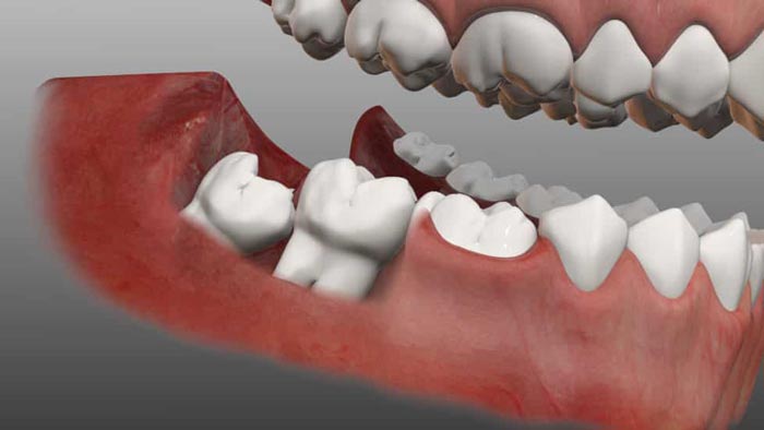 جراحی دندان عقل نهفته: جلوگیری از آسیب دندانها با کشیدن دندان عقل