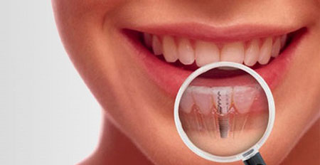 آیا فواید ایمپلنت دندان در زیبایی لبخند بیشتر است یا معایب آن؟