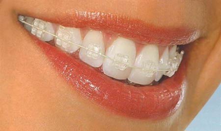 ارتودنسی ثابت برای درمان ناهنجاری و بی نظمی شدید دندان