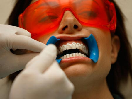 فلوروسیس:ایجاد لکه های سفید روی دندان ناشی از مصرف زیاد فلوراید
