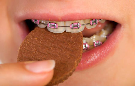 تغذیه و رژیم غذایی ارتودنسی:بایدها و نبایدهای خوراکی سیم کشی دندان