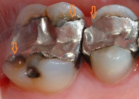 علت و درمان حساسیت دندانی و تیر کشیدن دندان های حساس