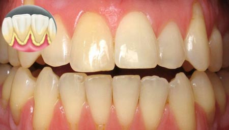 علت و درمان حساسیت دندانی و تیر کشیدن دندان های حساس