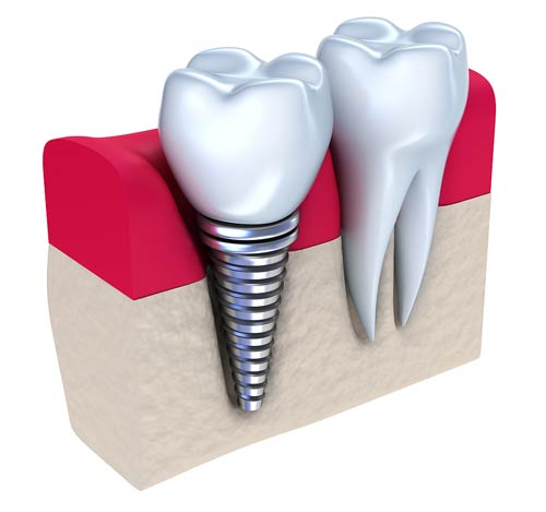 سوالات رایج ایمپلنت دندان و پاسخ به پرسش های متداول کاشت دندان