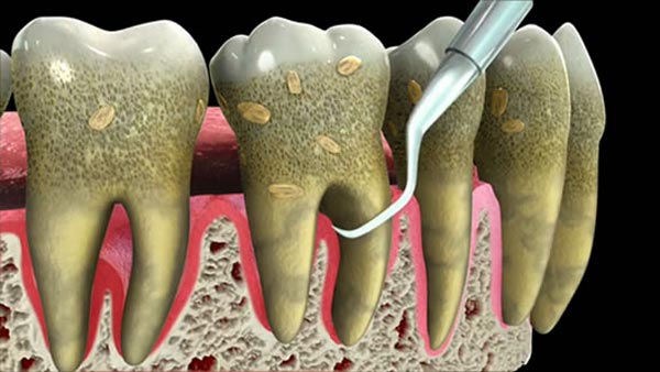 جرم گیری دندان:صیقل و پولش دادن دندان با تصحیح سطح ریشه و بروساژ