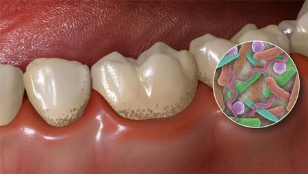 درمان پلاک و جرم دندان:تخریب مینا دندان با باکتری‌های بیماری‌زا