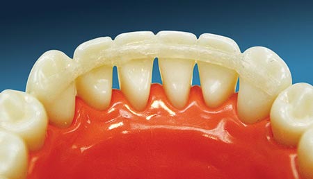 لق شدن دندان دائمی در اثر آسیب استخوان و رباط نگه دارنده دندان لق
