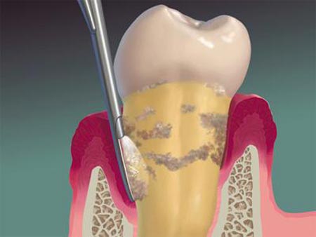 لق شدن دندان دائمی در اثر آسیب استخوان و رباط نگه دارنده دندان لق
