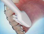 آموزش مسواک زدن و نخ دندان کشیدن در ارتودنسی برای سلامتی دندان