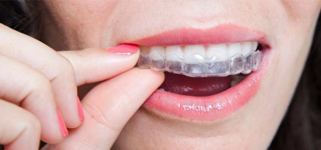 نایت گارد (محافظ دهانی،محافظ دندانی):کاهش فشار به دندان‌ و فک‌