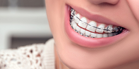 اپن بایت (فاصله بین دندان بالا و پایین):درمان مشکلات گفتار و زیبایی