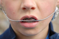 ارتودنسی: دندان‌هایی ردیف و مرتب با سیم کشی دندان