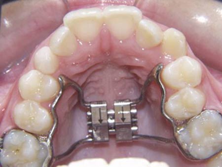 ارتودنسی: دندان‌هایی ردیف و مرتب با سیم کشی دندان
