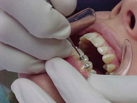 ارتودنسی با براکت یا بریس فلزی بهترین روش در مرتب کردن دندانها