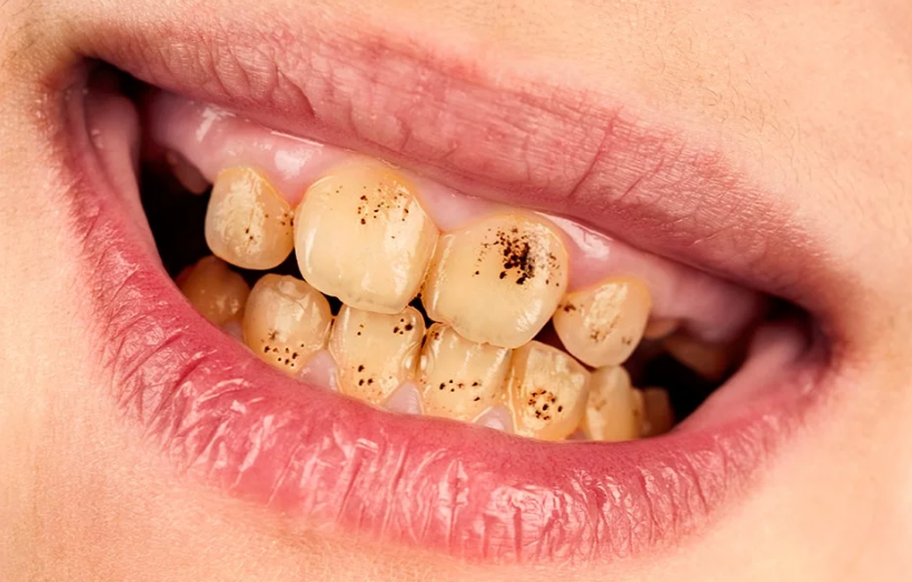 لکه سیاه، زرد و قهوه ای دندان:لبخند جذاب با درمان تغییر رنگ دندان