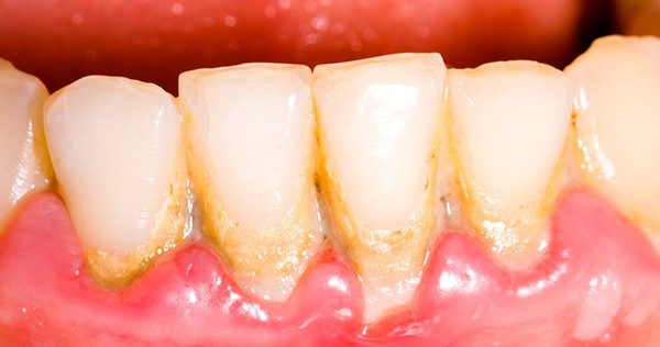 لکه سیاه، زرد و قهوه ای دندان:لبخند جذاب با درمان تغییر رنگ دندان