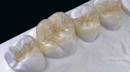 پر کردن دندان بهترین روش ترمیم بخش آسیب دیده دندان