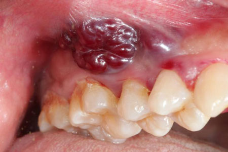 رابطه بیماریهای شایع دهان، دندان و لثه کودکان و بزرگسالان و بهداشت دهان