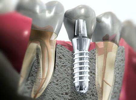 درمان ترک و شکستگی دندان:جلوگیری از تجمع باکتری در دندان شکسته