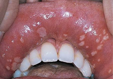 درمان آفت دهان، زبان و لثه با لیزر و درمان خانگی