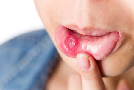 درمان آفت دهان، زبان و لثه با لیزر و درمان خانگی