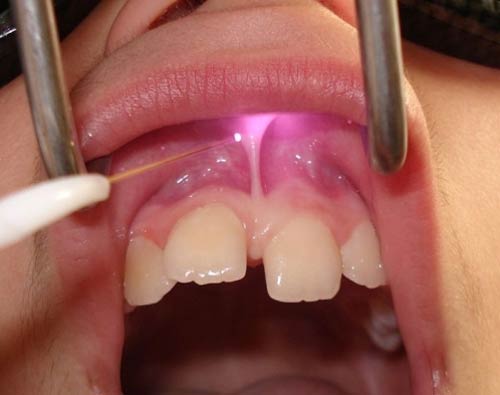فرنکتومی با لیزر (جراحی برداشت بند زیر زبان و لب) بدون خونریزی