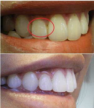 مزیت های پرسلین ونیر نسبت به سایر روش های زیبایی دندان