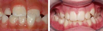 درمان کراس بایت و پیشگیری از انحراف قوس دندانی و اختلال جویدن