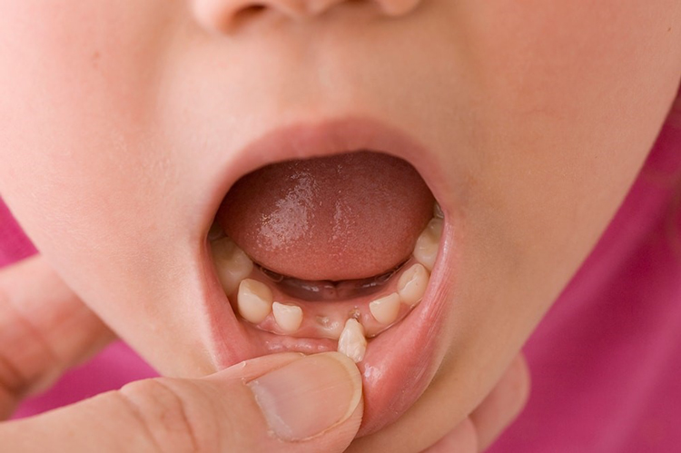 لق شدن دندان شیری و دائمی کودکان در اثر ضربه و بیماریهای لثه و درمان