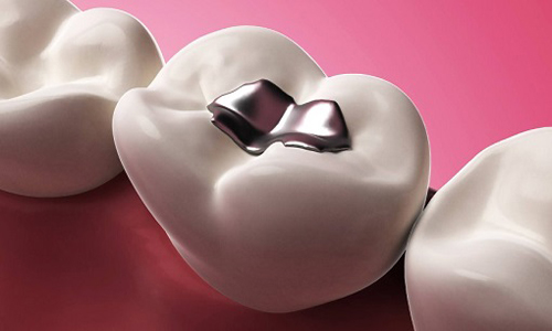 مزایا و مضرات آمالگام دندانپزشکی برای پرکردن و ترمیم دندان های خراب