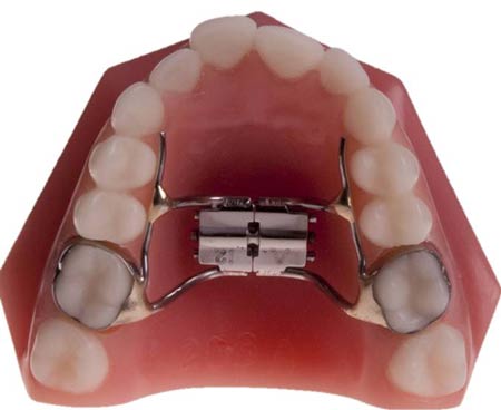 ارتودنسی متحرک:اصلاح جزیی اختلالات فک و دندان با پلاک متحرک
