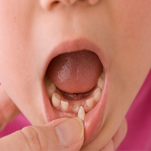لق شدن دندان شیری و دائمی کودکان در اثر ضربه و بیماریهای لثه و درمان