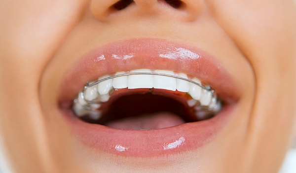 نگه دارنده (پلاک،ریتینر):پیشگیری از نامرتبی دندان بعد از ارتودنسی