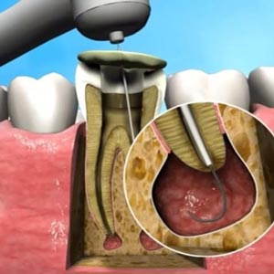 آبسه دندان: درمان عفونت لثه با حذف عفونت باکتریایی و جراحی