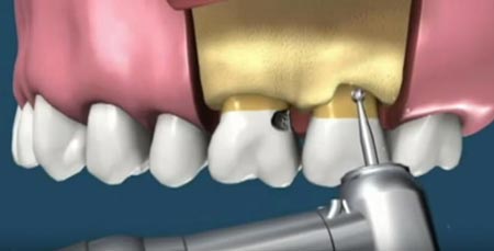 افزایش طول تاج دندان:بهبود لبخند و ترمیم لثه‌ ناصاف باجراحی و لیزر