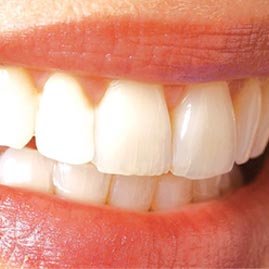 افزایش طول تاج دندان:بهبود لبخند و ترمیم لثه‌ ناصاف باجراحی و لیزر
